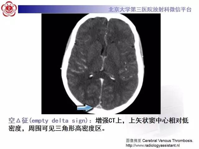 【病例】颅内静脉窦血栓形成1例CT及MR