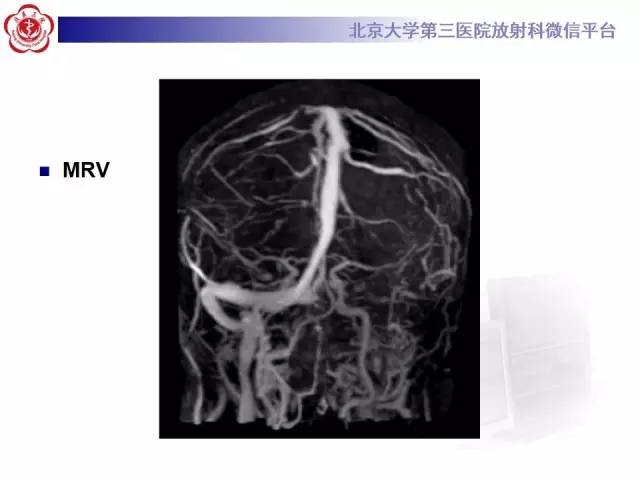 【病例】颅内静脉窦血栓形成1例CT及MR