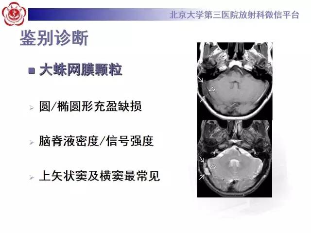 【病例】颅内静脉窦血栓形成1例CT及MR