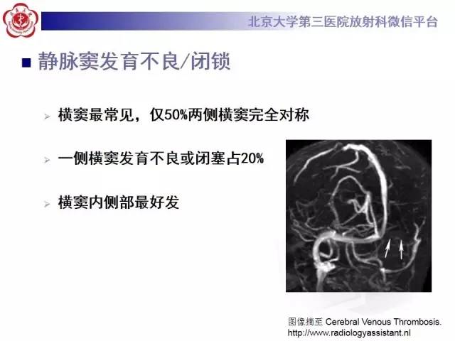 【病例】颅内静脉窦血栓形成1例CT及MR