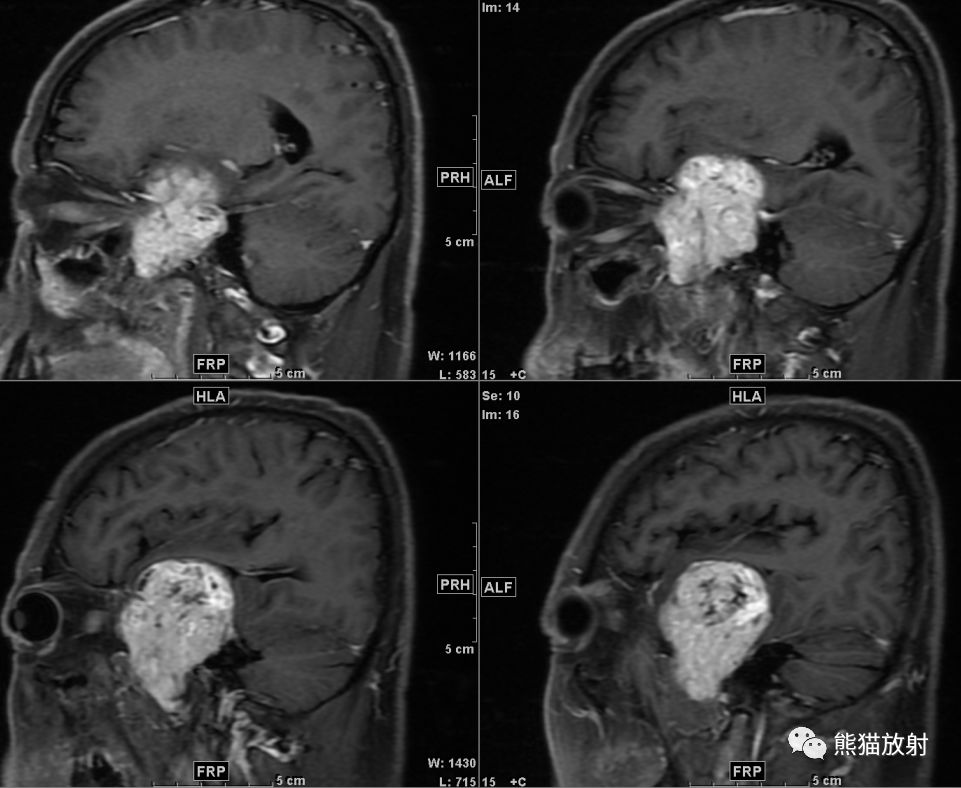 【病例】鞍旁占位性病变3例MR影像对比读片 【病例】鞍旁占位性病变3例MR影像对比读片