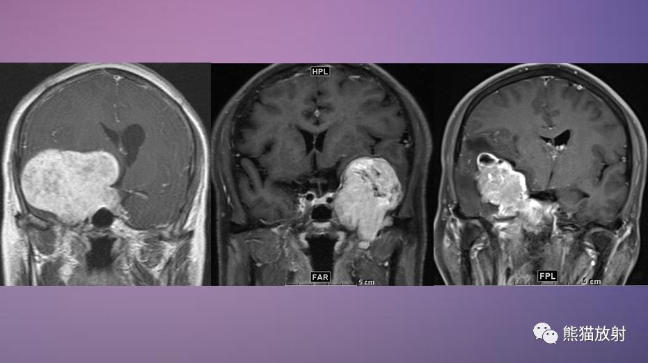 【病例】鞍旁占位性病变3例MR影像对比读片 【病例】鞍旁占位性病变3例MR影像对比读片