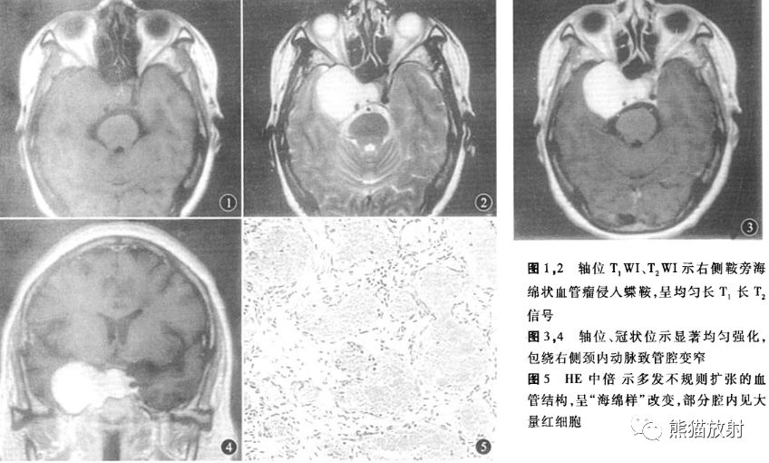 【病例】鞍旁占位性病变3例MR影像对比读片 【病例】鞍旁占位性病变3例MR影像对比读片