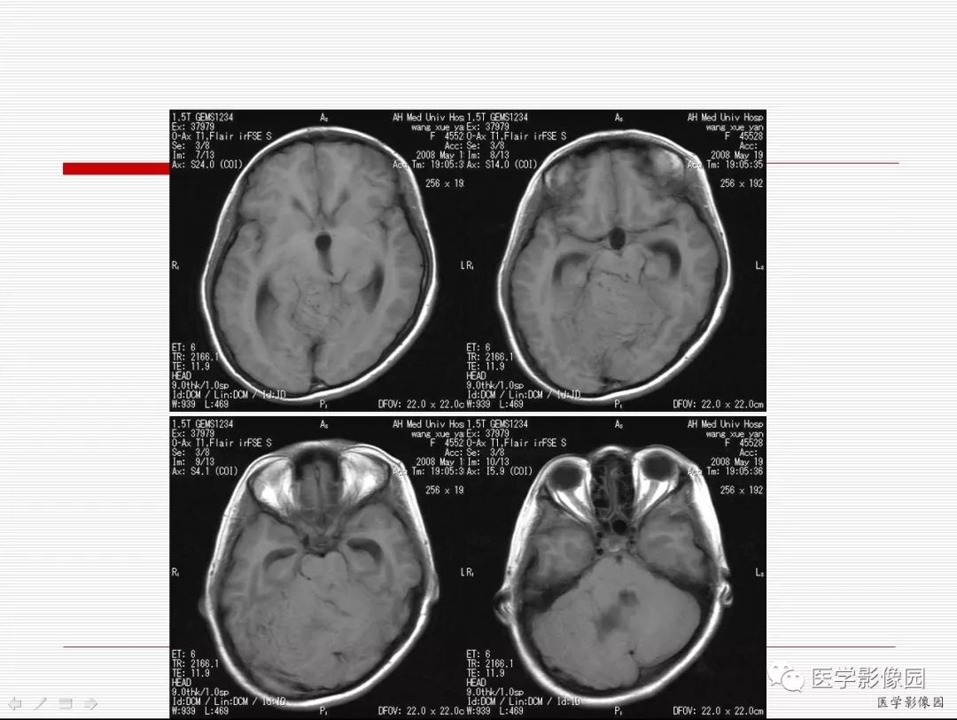 【病例】小脑发育不良性节细胞瘤1例MR影像表现
