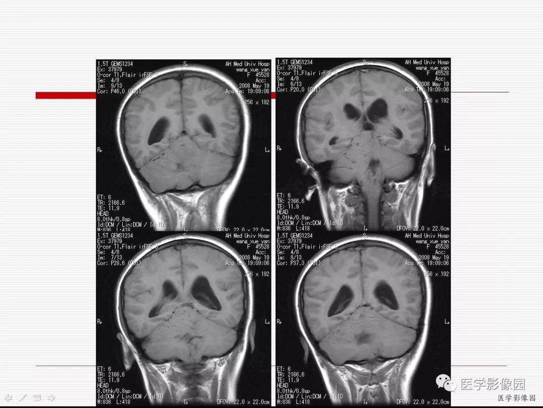 【病例】小脑发育不良性节细胞瘤1例MR影像表现