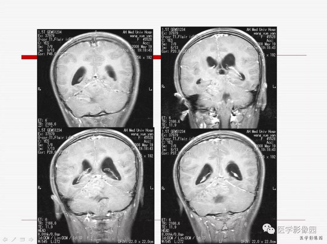 【病例】小脑发育不良性节细胞瘤1例MR影像表现
