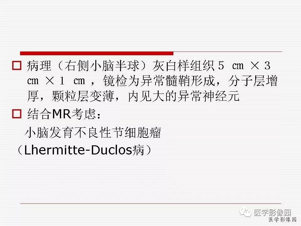【病例】小脑发育不良性节细胞瘤1例MR影像表现