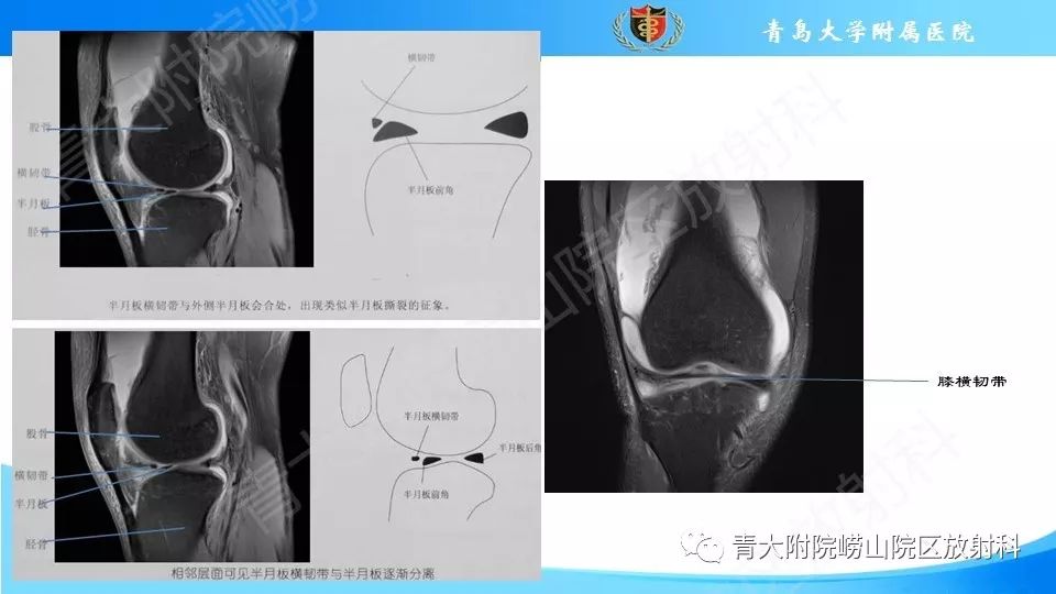 【PPT】外侧半月板“假撕裂征”