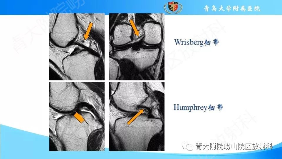 【PPT】外侧半月板“假撕裂征”
