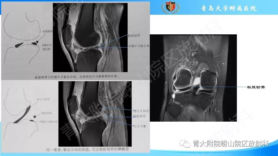 【PPT】外侧半月板“假撕裂征”