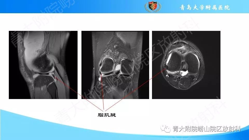 【PPT】外侧半月板“假撕裂征”