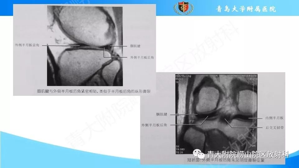【PPT】外侧半月板“假撕裂征”