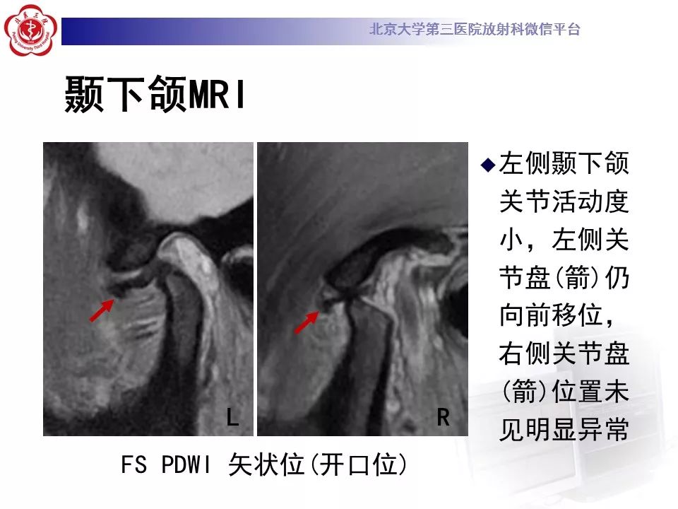 【病例】颞下颌关节紊乱病1例MR影像诊断