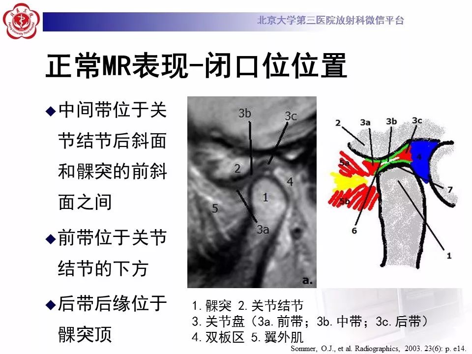 【病例】颞下颌关节紊乱病1例MR影像诊断