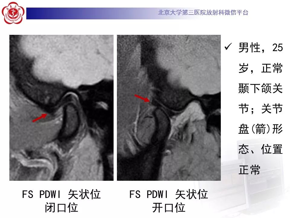 【病例】颞下颌关节紊乱病1例MR影像诊断