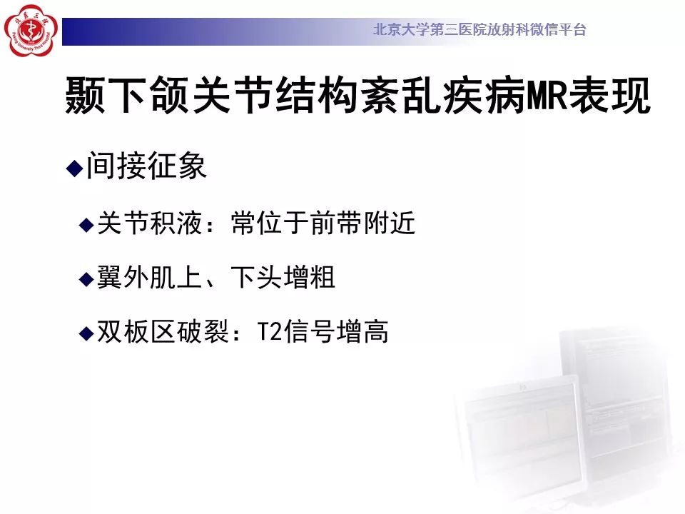 【病例】颞下颌关节紊乱病1例MR影像诊断