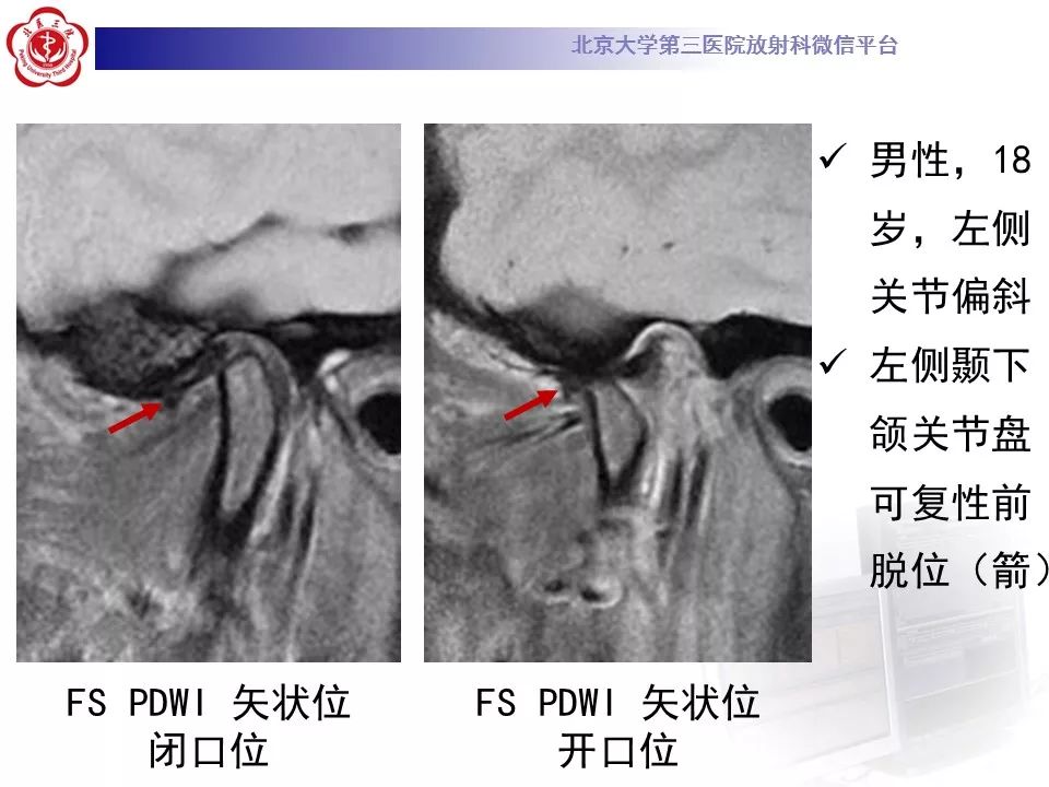 【病例】颞下颌关节紊乱病1例MR影像诊断