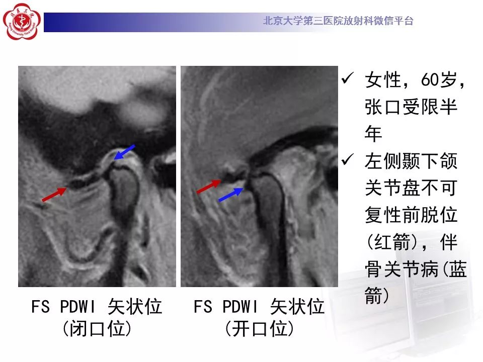 【病例】颞下颌关节紊乱病1例MR影像诊断