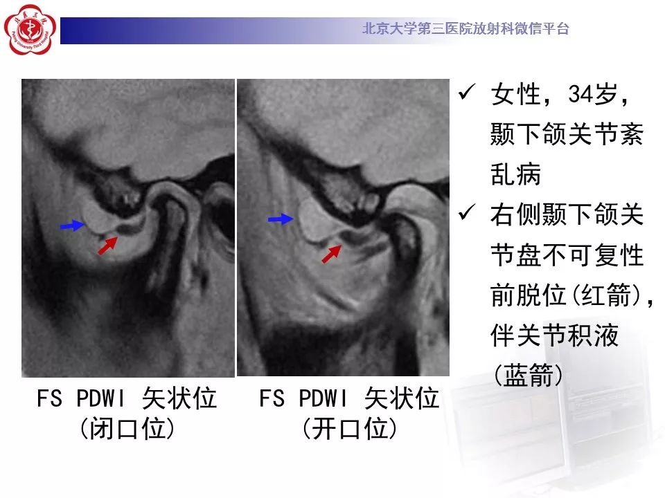 【病例】颞下颌关节紊乱病1例MR影像诊断