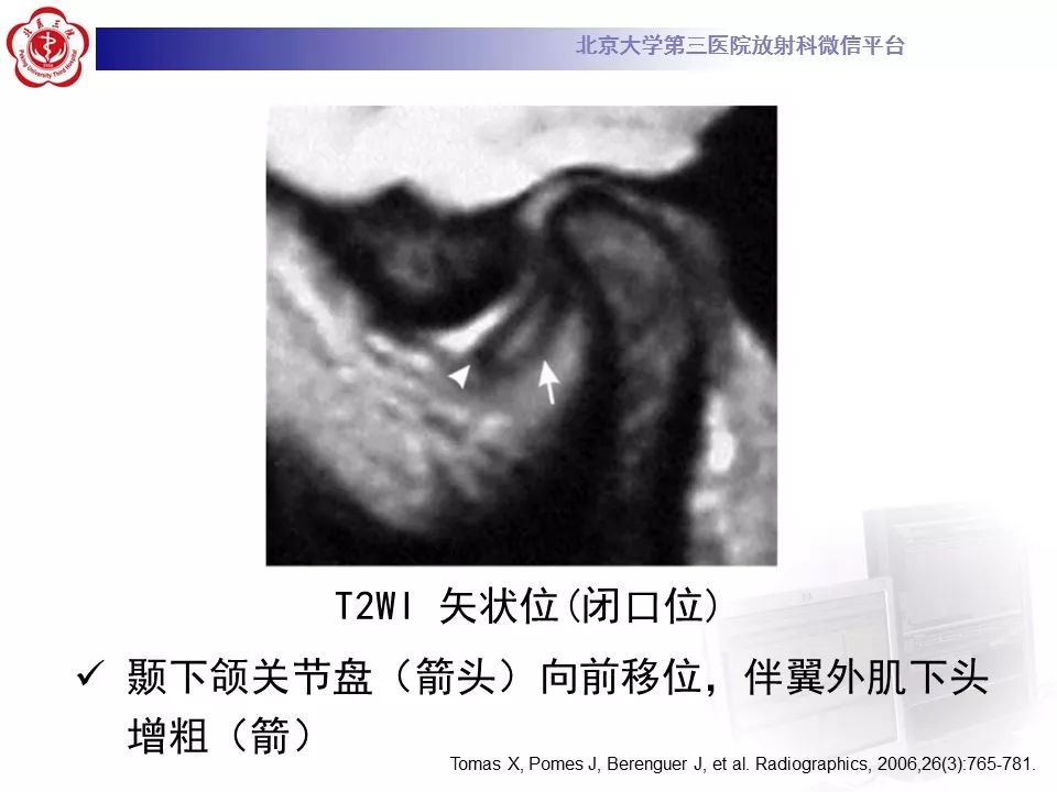 【病例】颞下颌关节紊乱病1例MR影像诊断