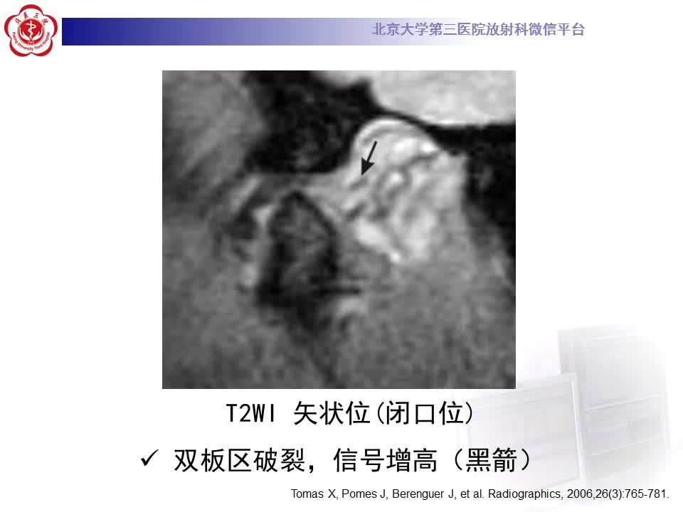 【病例】颞下颌关节紊乱病1例MR影像诊断