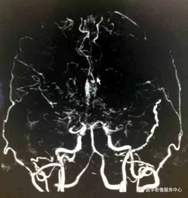 【病例】Moyamoya病1例CT 【病例】Moyamoya病1例CT