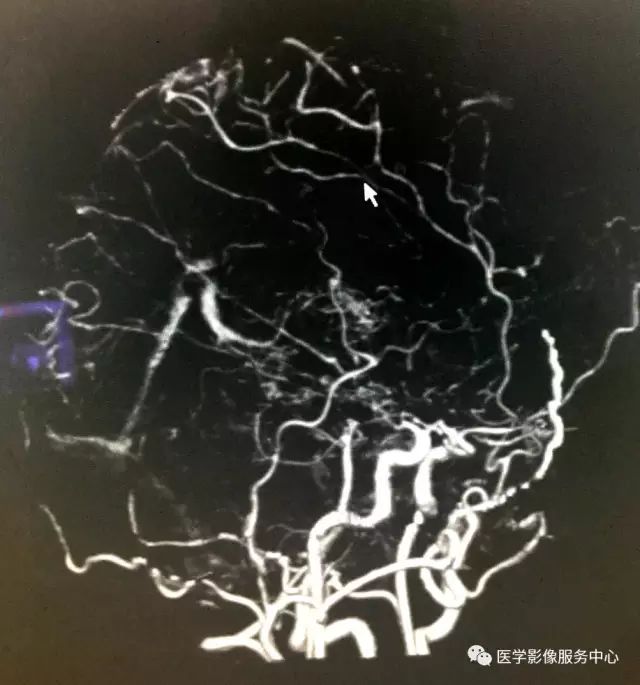 【病例】Moyamoya病1例CT 【病例】Moyamoya病1例CT
