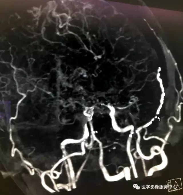 【病例】Moyamoya病1例CT 【病例】Moyamoya病1例CT