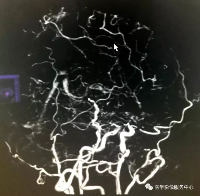 【病例】Moyamoya病1例CT 【病例】Moyamoya病1例CT
