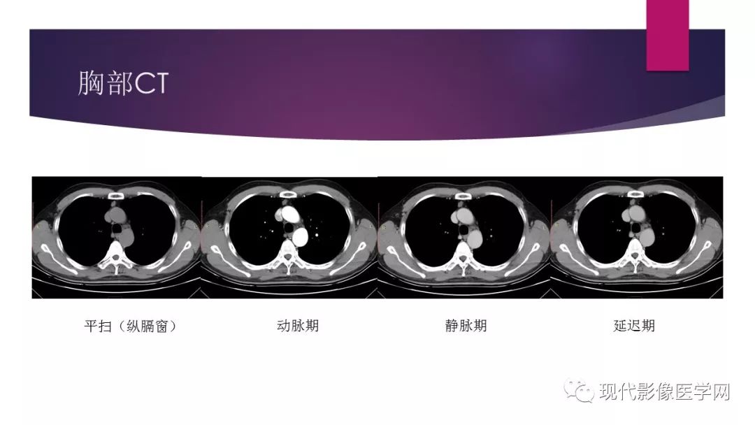 【病例】纵隔支气管源性囊肿1例CT影像表现