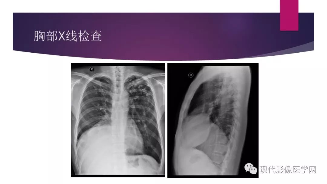 【病例】胸腺神经内分泌癌1例CT影像表现