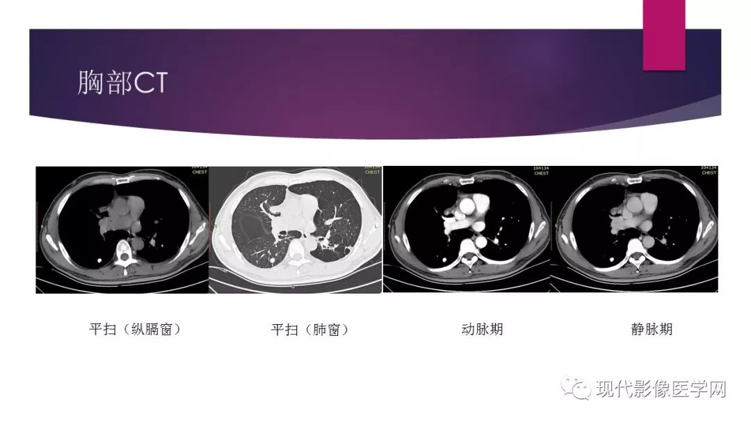 【病例】胸腺神经内分泌癌1例CT影像表现