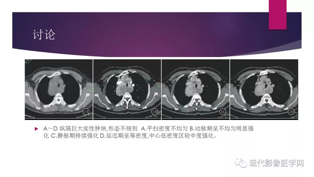 【病例】胸腺神经内分泌癌1例CT影像表现