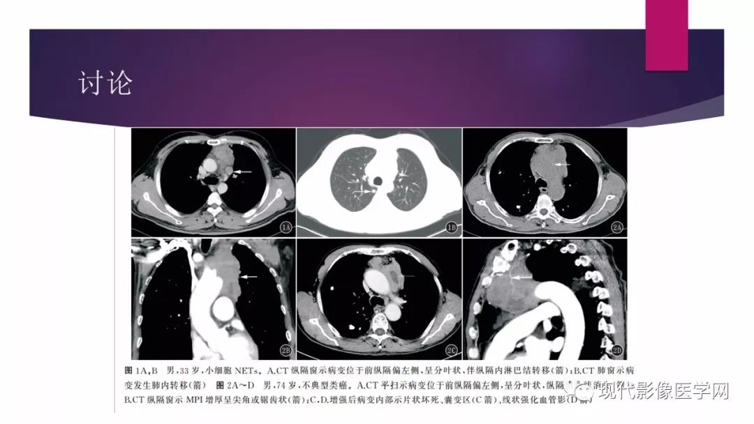 【病例】胸腺神经内分泌癌1例CT影像表现