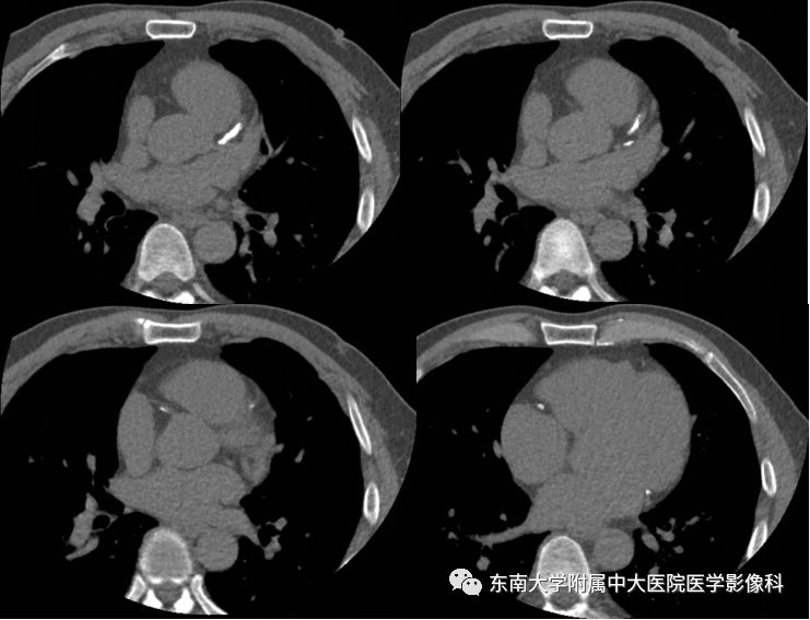 【病例】冠脉CTA一例—冠脉疾病报告和数据系统