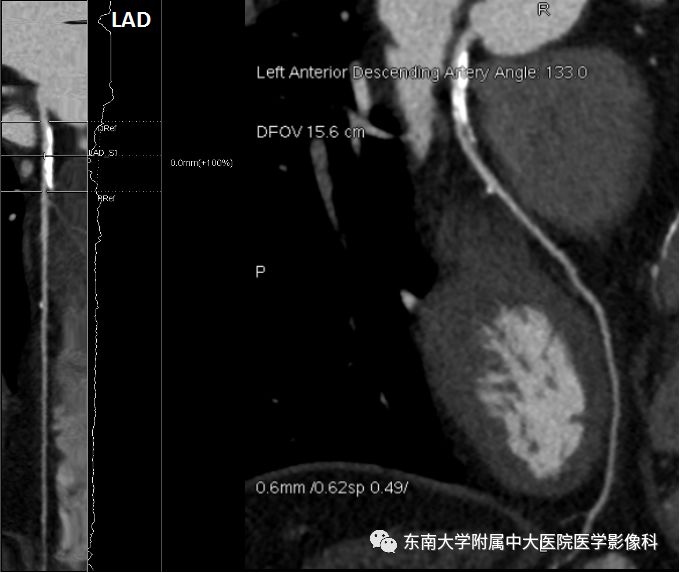 【病例】冠脉CTA一例—冠脉疾病报告和数据系统