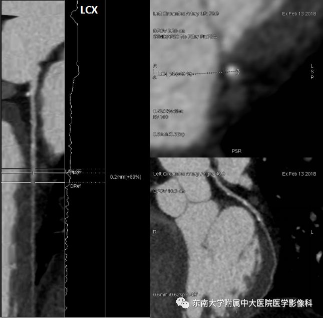 【病例】冠脉CTA一例—冠脉疾病报告和数据系统