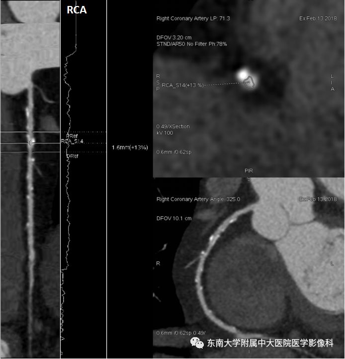 【病例】冠脉CTA一例—冠脉疾病报告和数据系统
