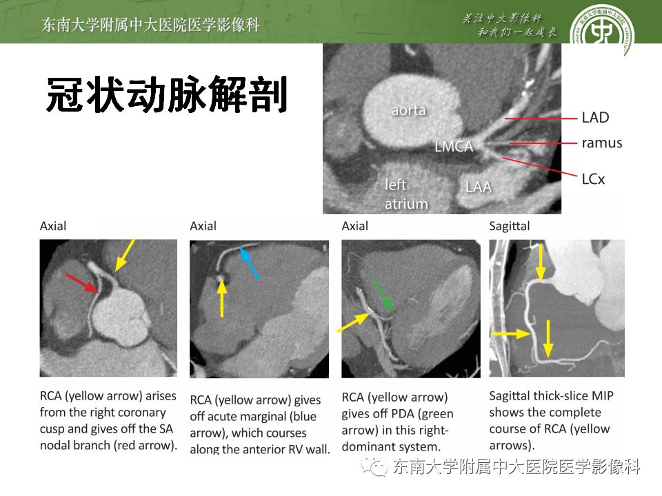 【病例】冠脉CTA一例—冠脉疾病报告和数据系统