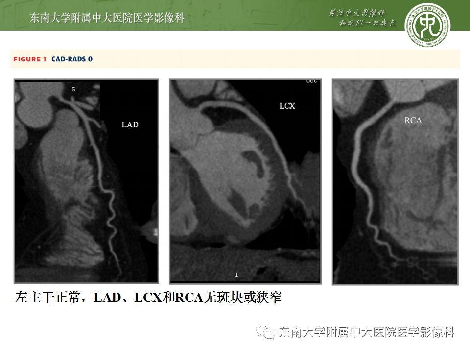 【病例】冠脉CTA一例—冠脉疾病报告和数据系统