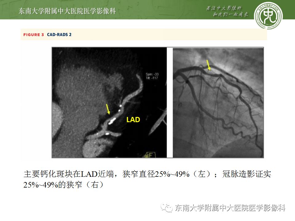 【病例】冠脉CTA一例—冠脉疾病报告和数据系统