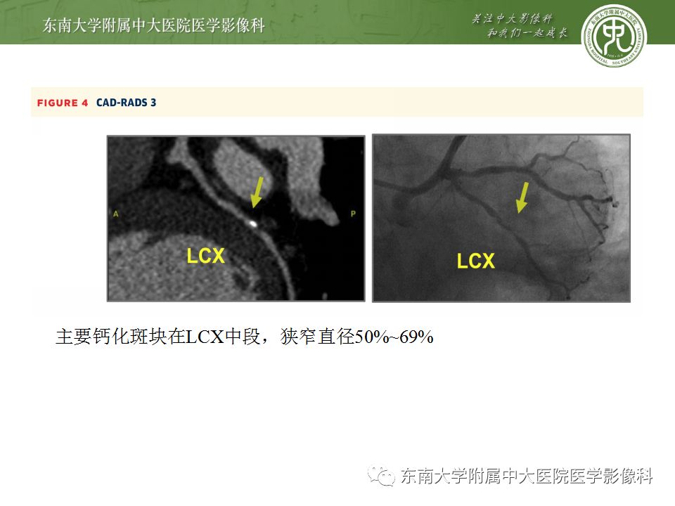 【病例】冠脉CTA一例—冠脉疾病报告和数据系统