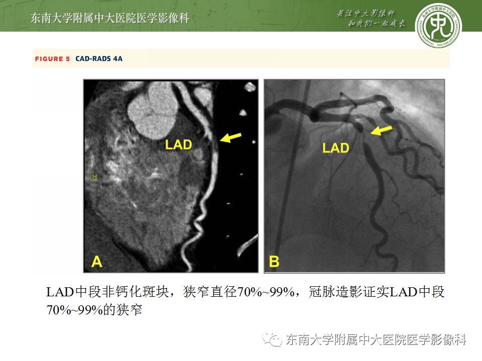 【病例】冠脉CTA一例—冠脉疾病报告和数据系统