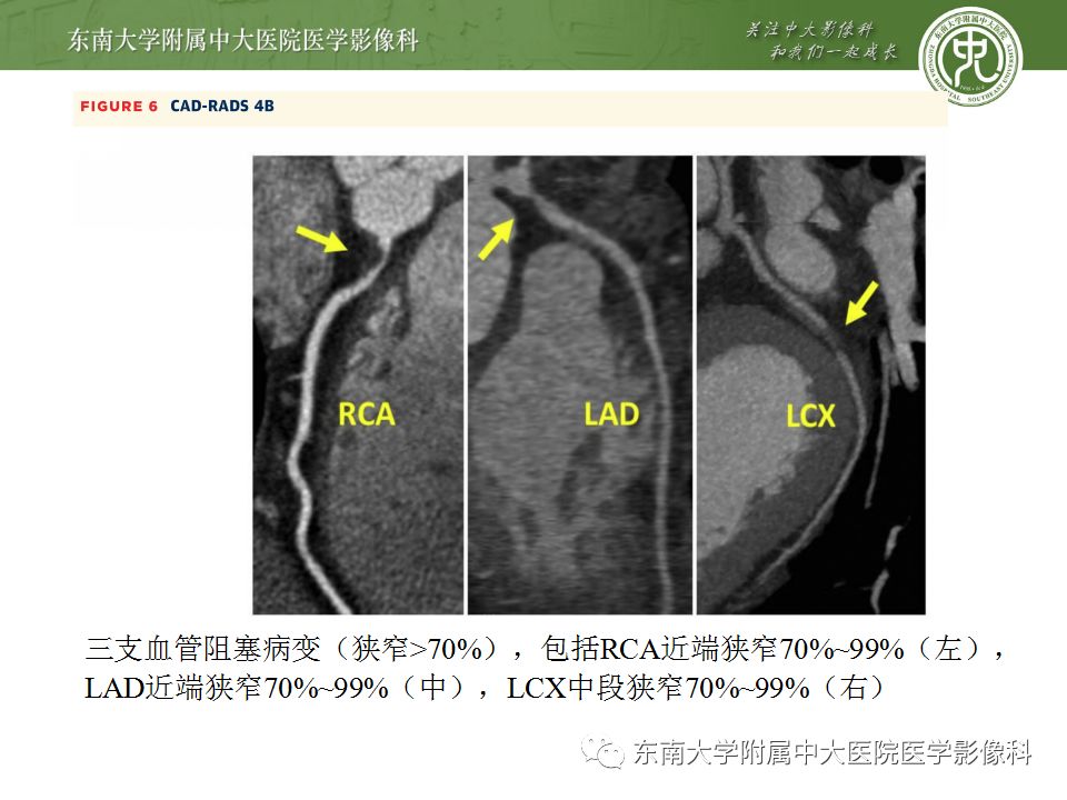 【病例】冠脉CTA一例—冠脉疾病报告和数据系统