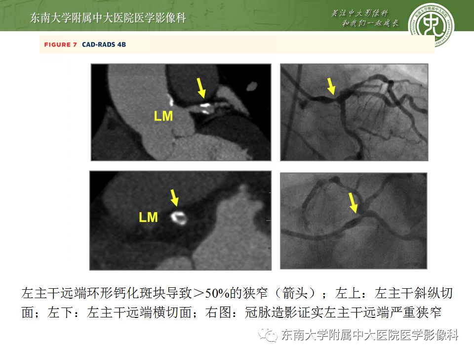 【病例】冠脉CTA一例—冠脉疾病报告和数据系统