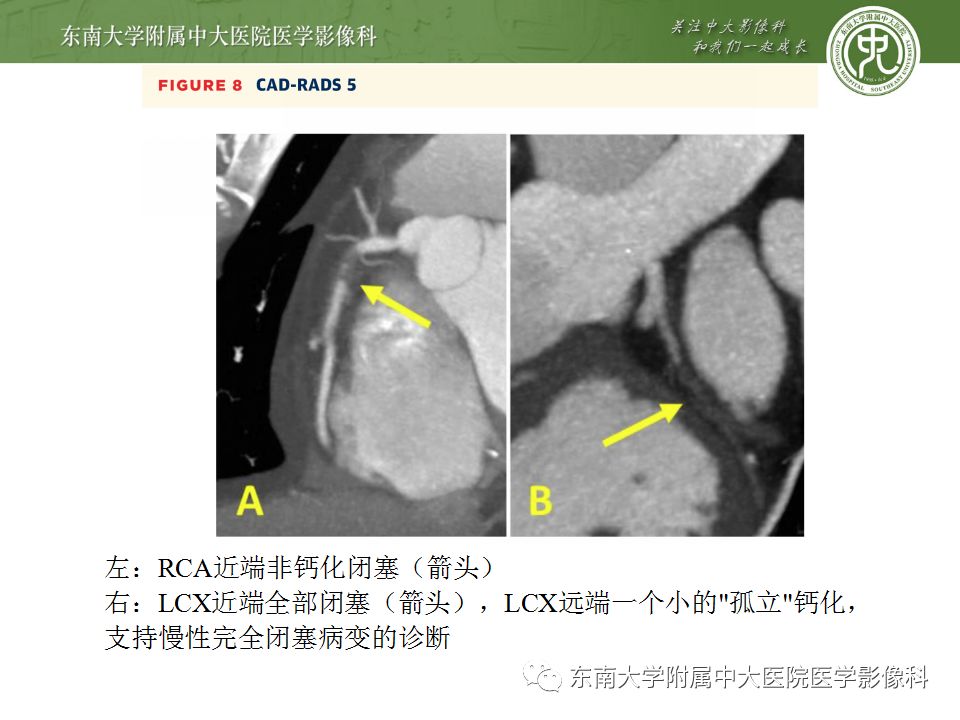【病例】冠脉CTA一例—冠脉疾病报告和数据系统