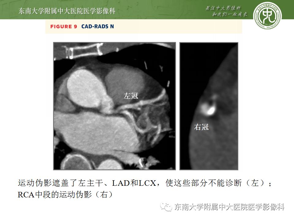 【病例】冠脉CTA一例—冠脉疾病报告和数据系统