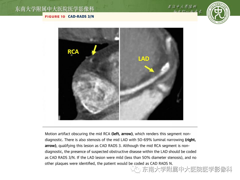 【病例】冠脉CTA一例—冠脉疾病报告和数据系统