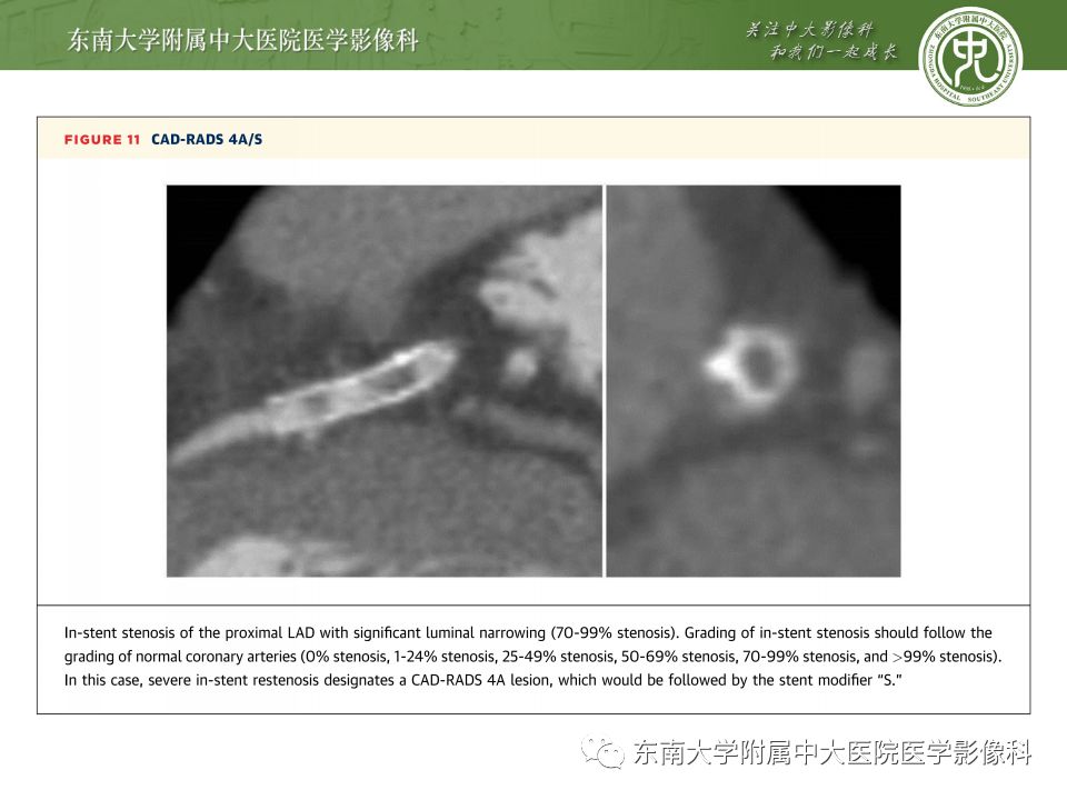 【病例】冠脉CTA一例—冠脉疾病报告和数据系统