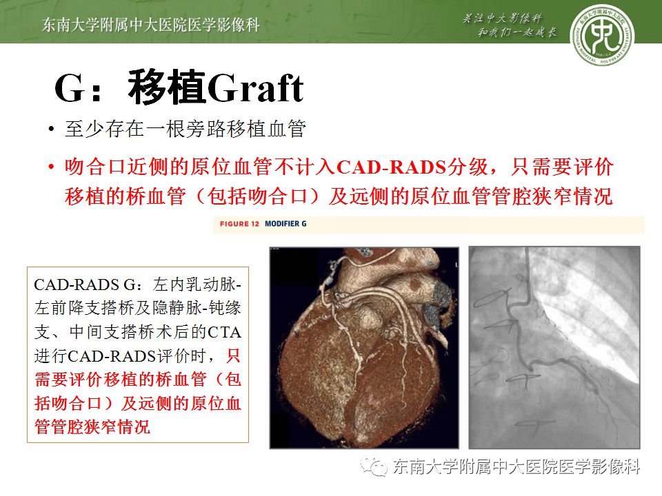 【病例】冠脉CTA一例—冠脉疾病报告和数据系统